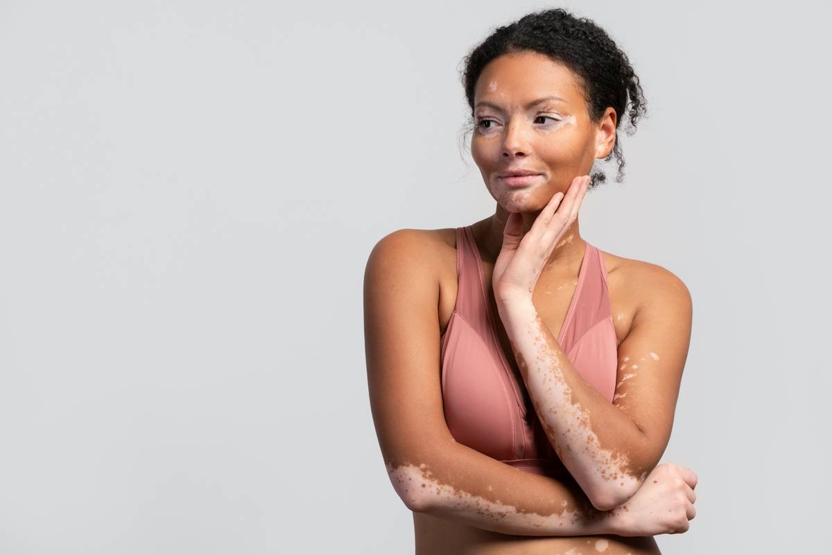 Restore your skin’s natural glow with Ayurvedic Treatment For Skin Disease! 🌱 Ayurveda offers holistic remedies using powerful herbs like Neem, Turmeric, and Aloe Vera to treat acne, eczema, psoriasis, and other skin conditions. Say goodbye to chemical-based treatments and embrace natural healing through herbal therapies, detoxification, and balanced nutrition. Let Ayurveda nurture your skin from within for a radiant, blemish-free look! ✨💚 Visit us now-https://svasthvida.com/services/ayurvedic-treatment-for-skin-care